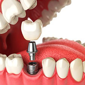 Dental Implants;